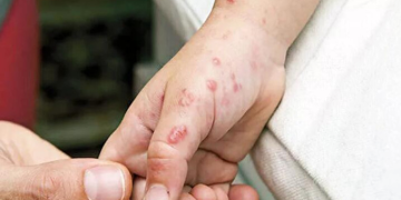 Ankara’da maymun çiçeği iddiası!