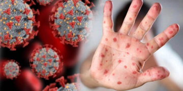 DSÖ’den kritik açıklama: Maymun çiçeği ve Kovid-19 bulaşma farkı…